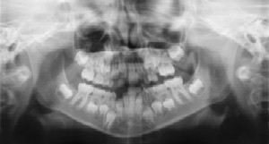 Dental Radiographs (X-Rays) - Pediatric Dentist in Ardmore, PA